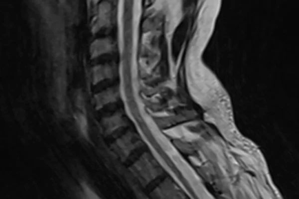 Adrenomyeloneuropathy Treatment Market Outlook 2035